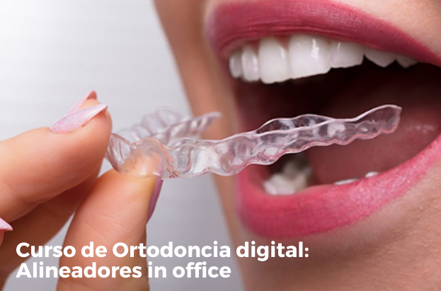 Ortodoncia Digital: Alineadores in Office